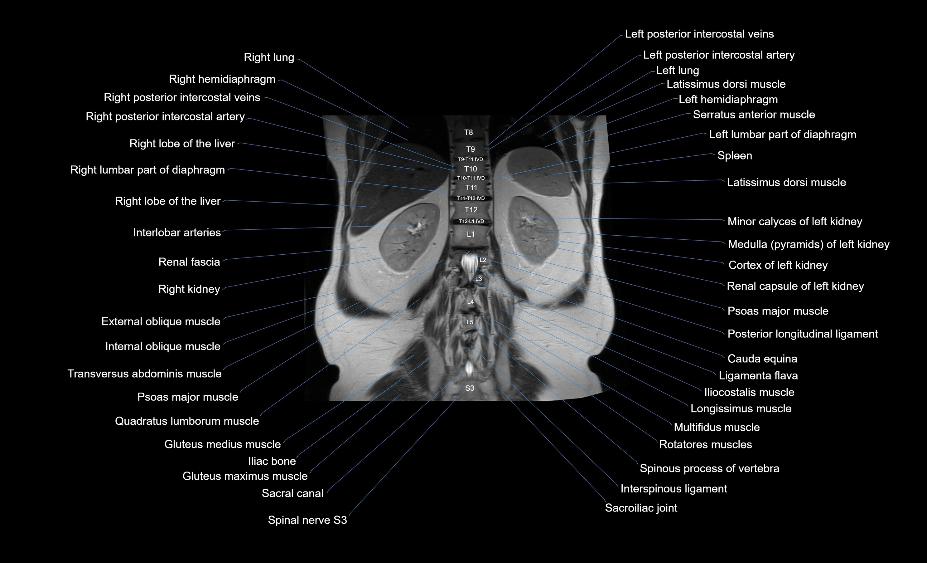 MRI Abdomen coronal labelled cross sectional anatomy radiology  image-img-00001-00044.webp